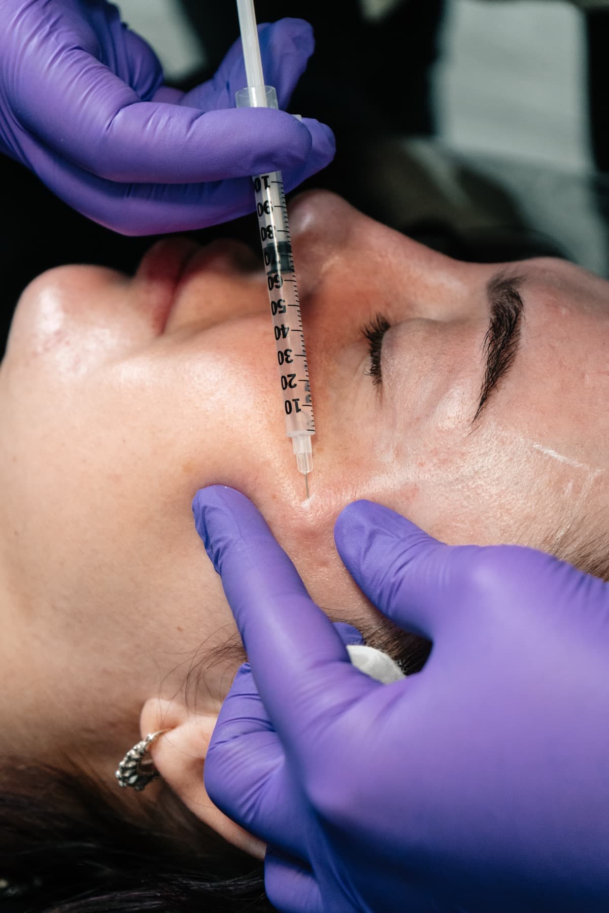 Filler dissolving treatment in progress at House of Riri
