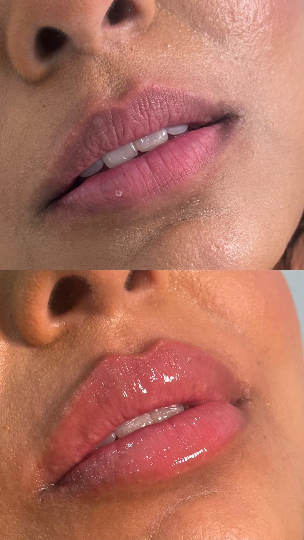 Close-up before and after lip filler result