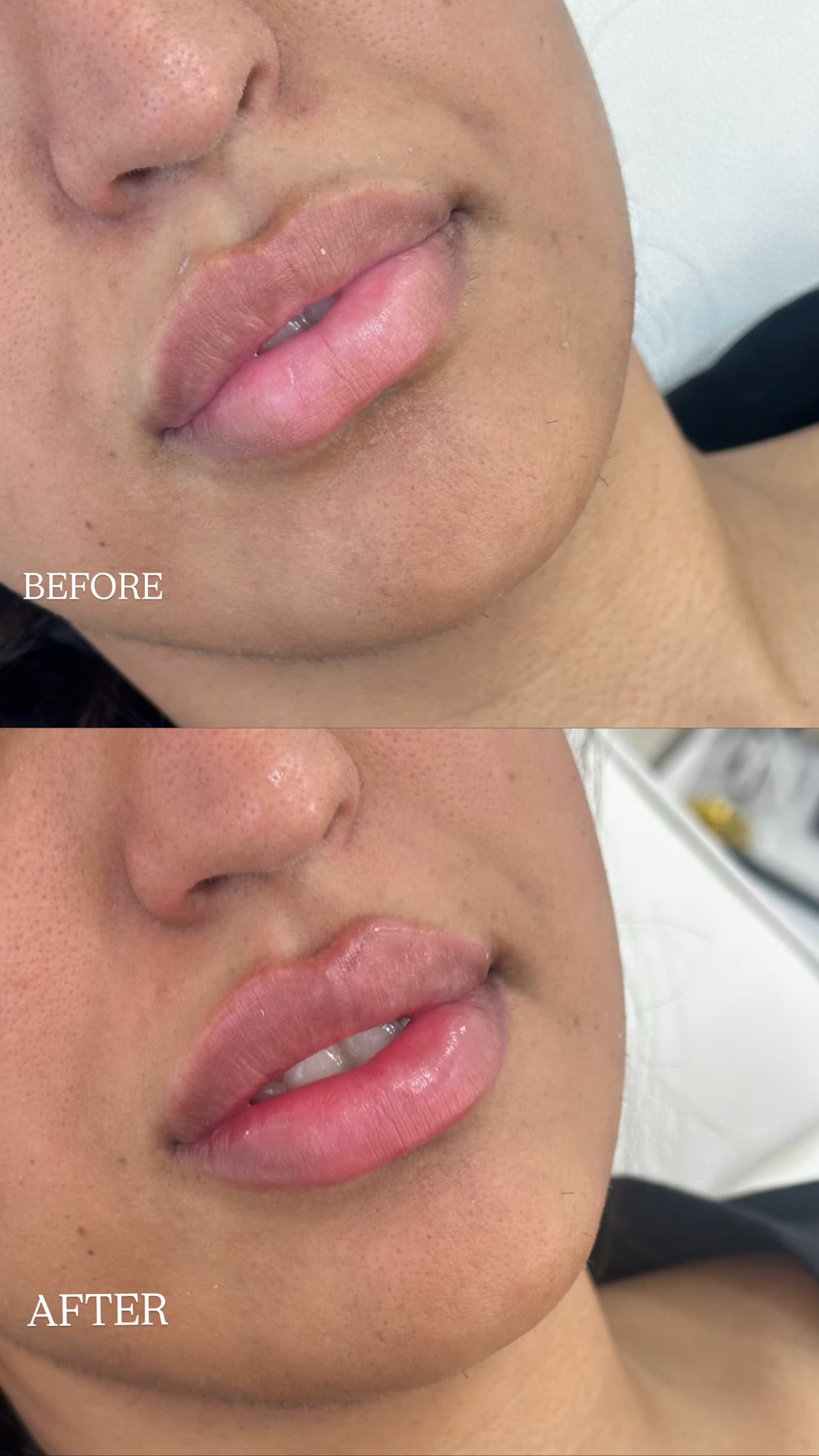 Close-up before and after lip filler result