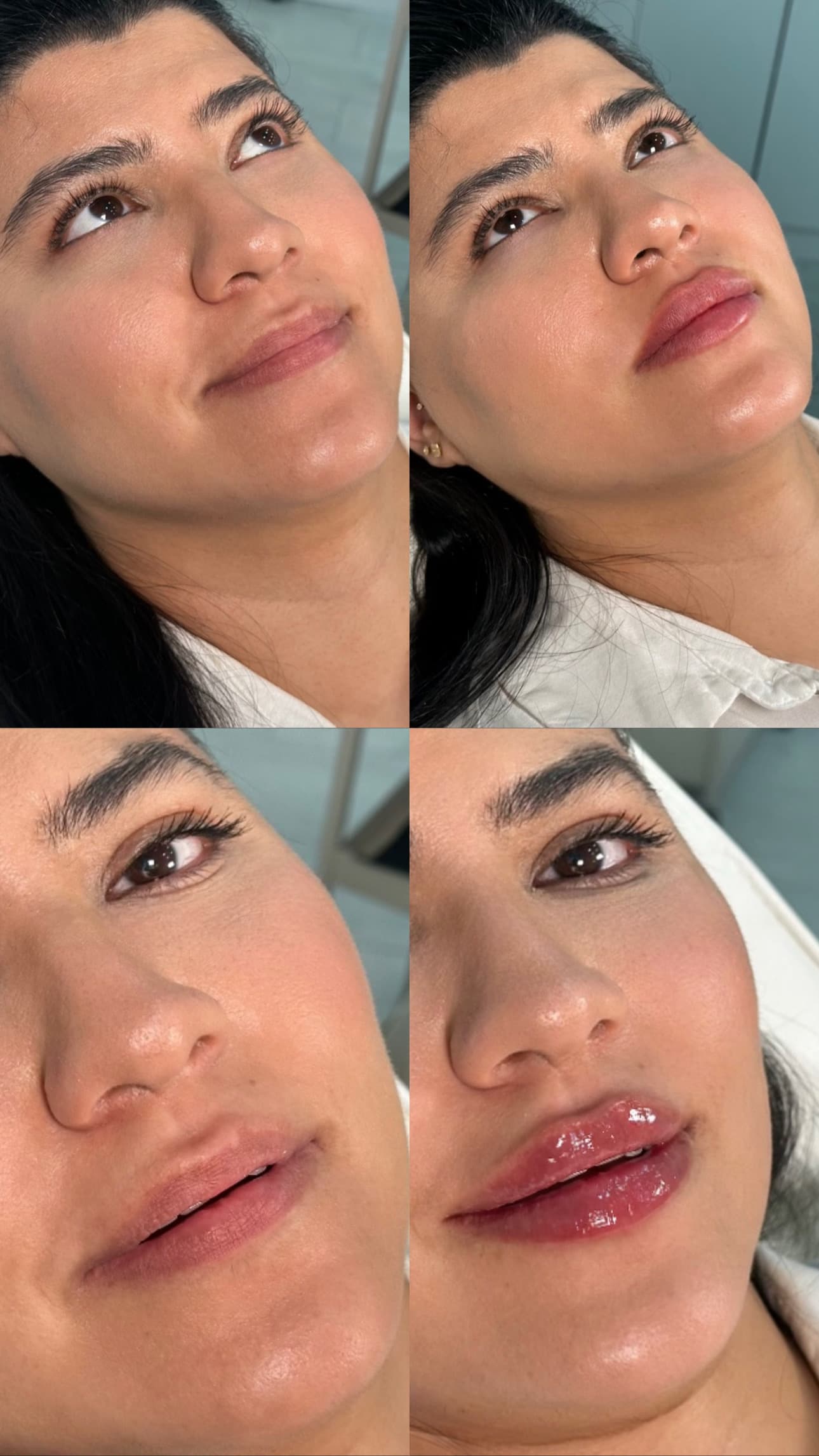 Four-panel before and after lip filler progression