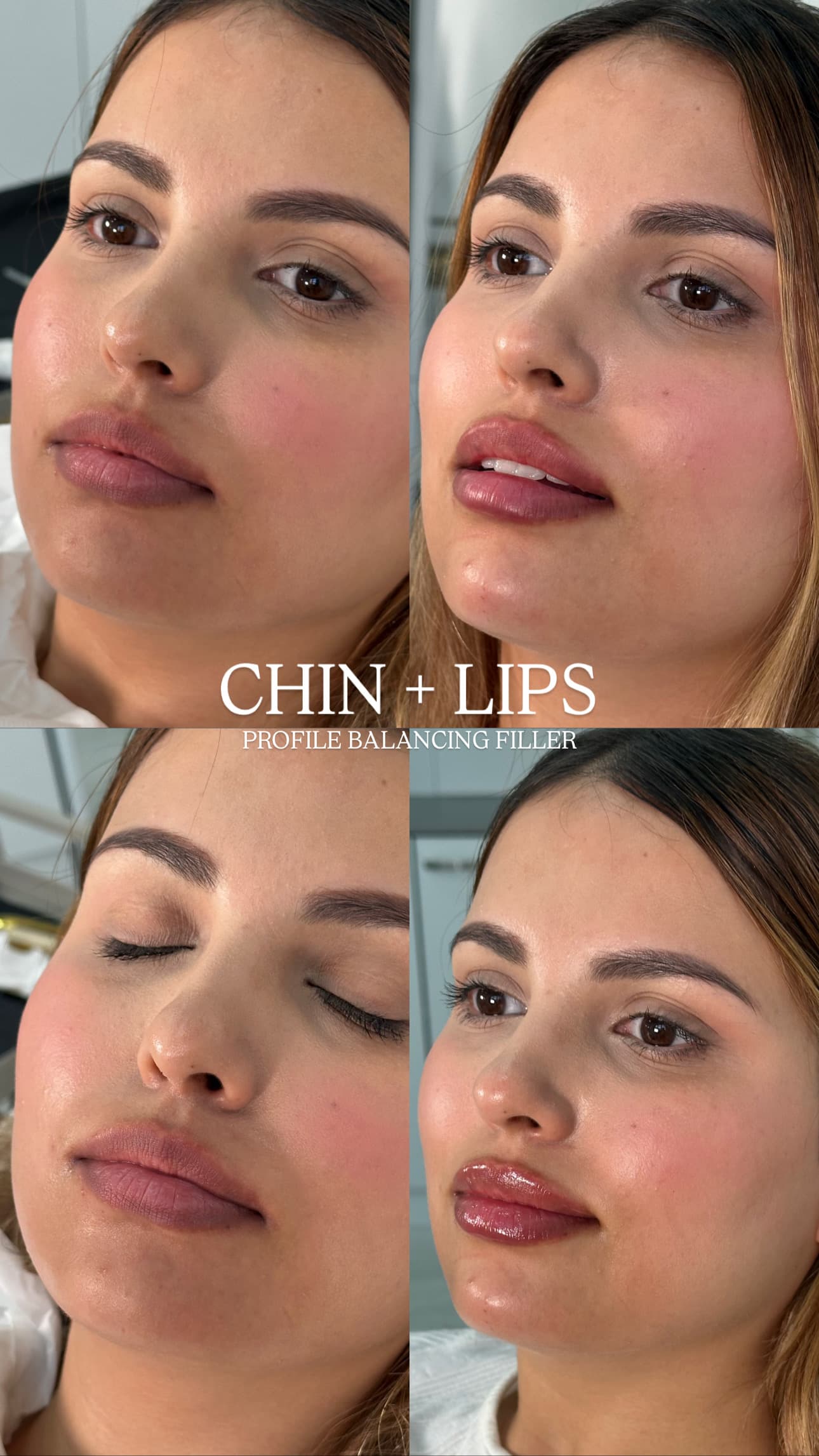 Before and after chin and lip profile balancing filler