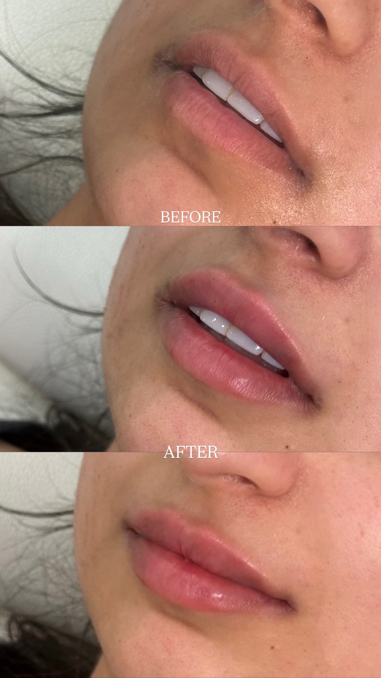 Close-up before and after lip filler result