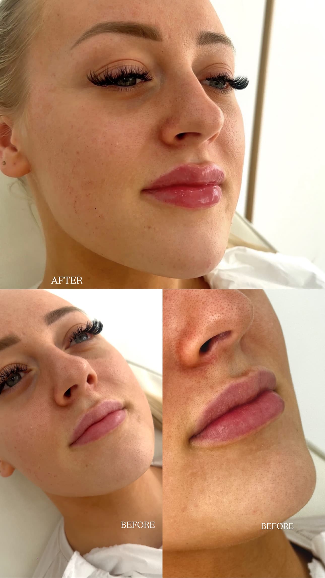 Before and after lip filler result, side profile