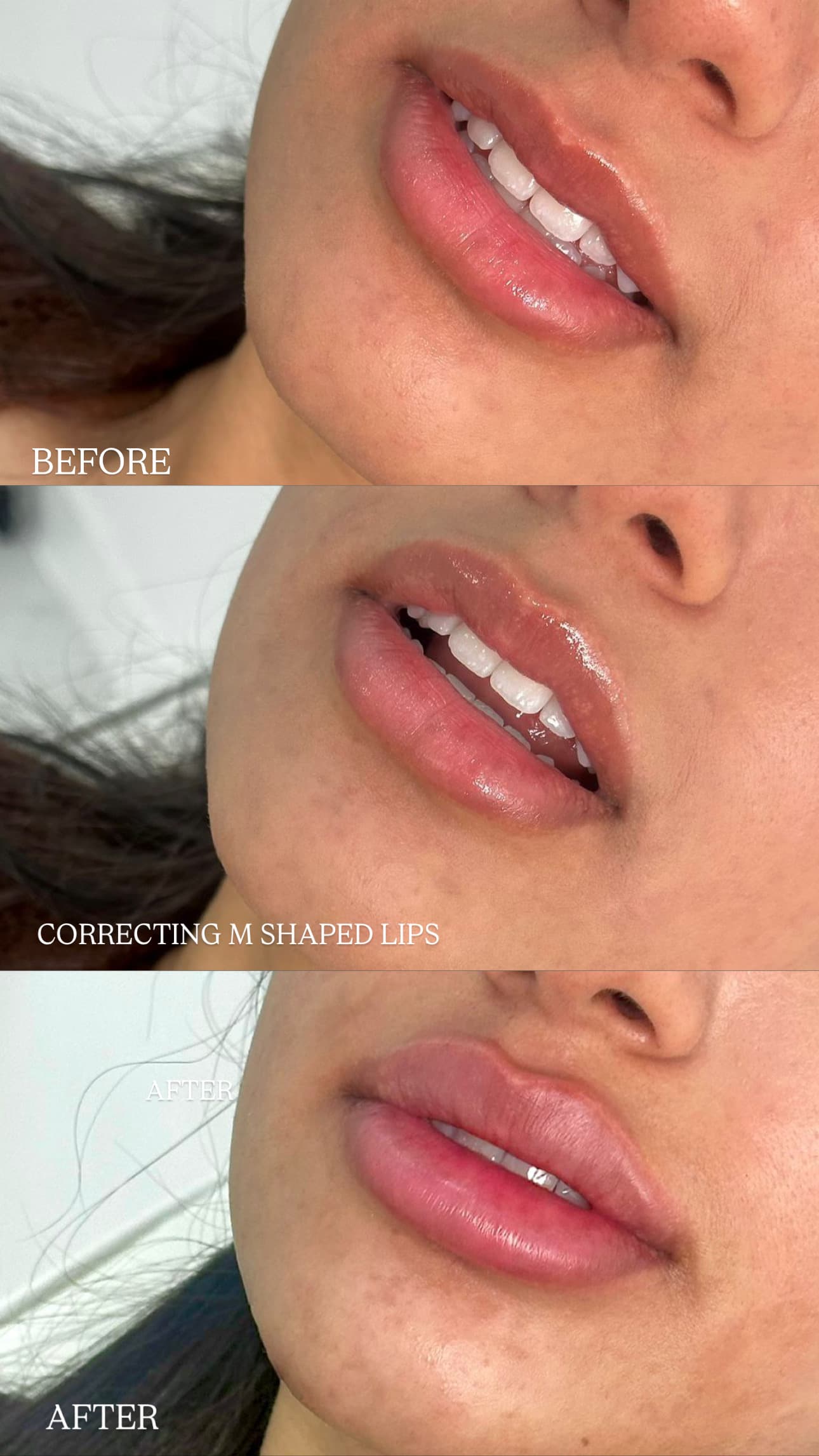 Before and after lip filler correcting an M-shaped lip line