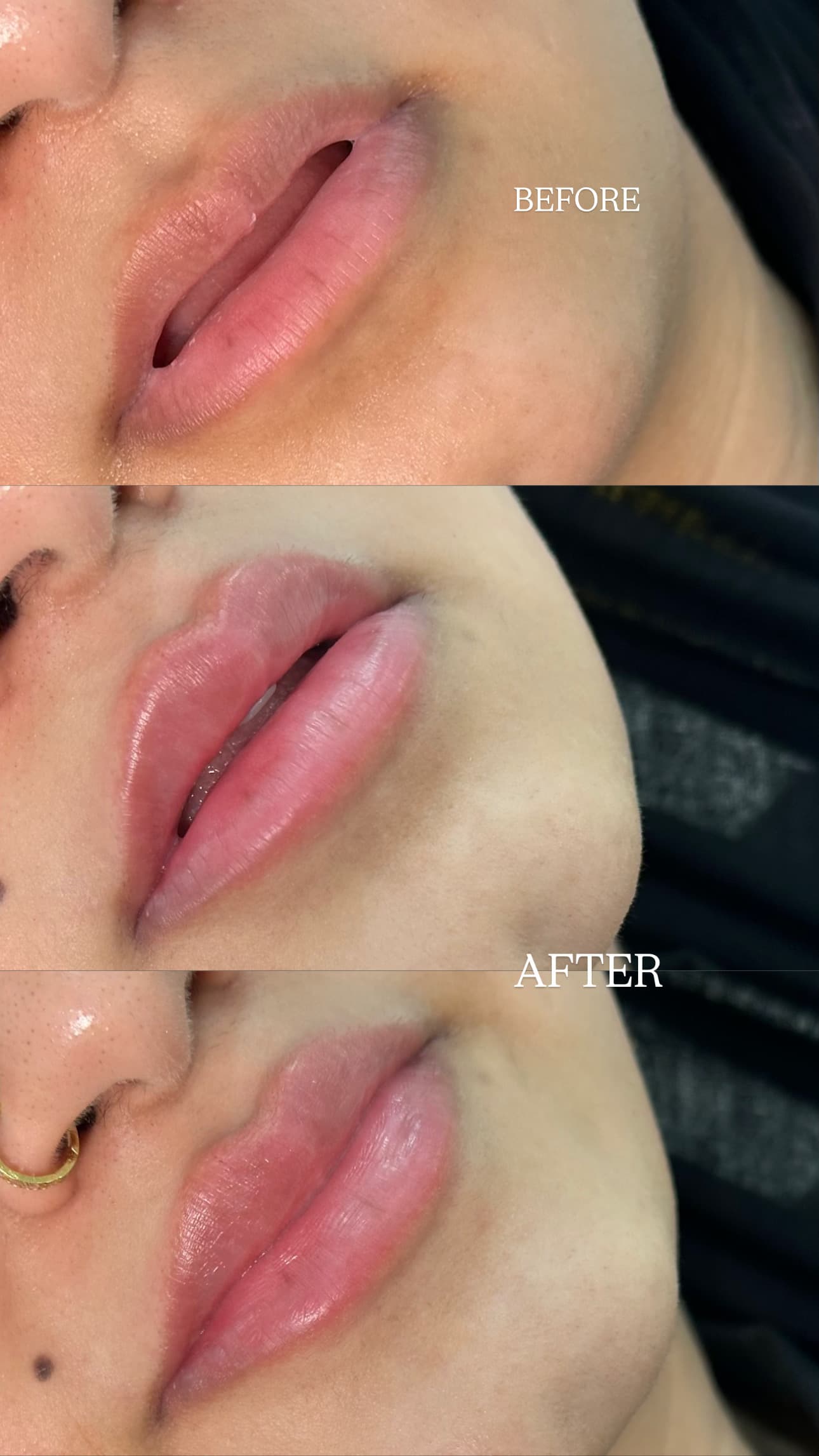 Close-up before and after lip filler result