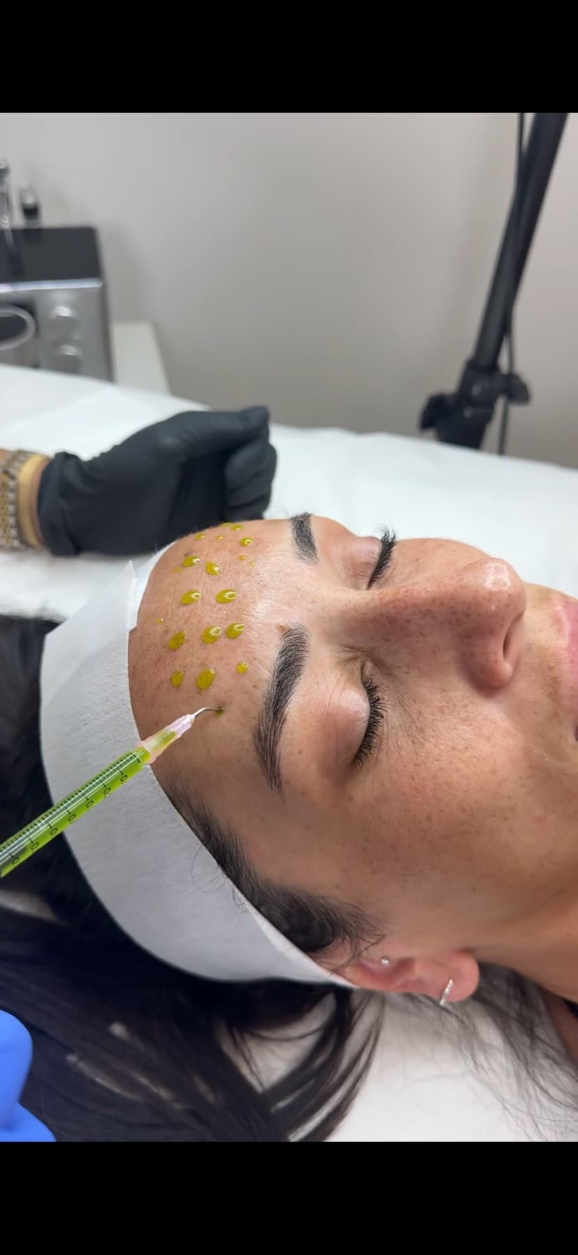 Close-up of a chemical peel facial treatment in progress