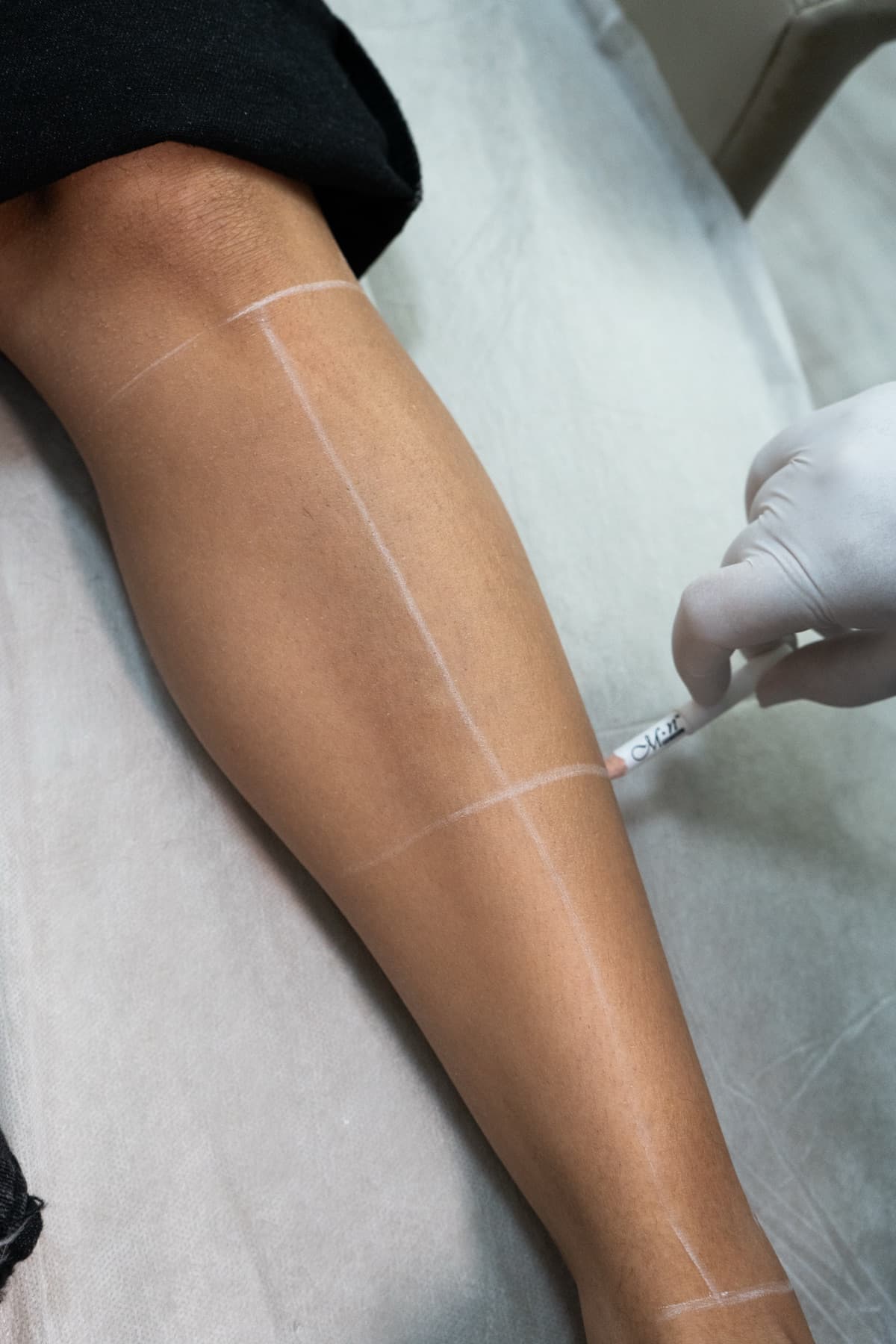 Treatment area marked before laser hair removal
