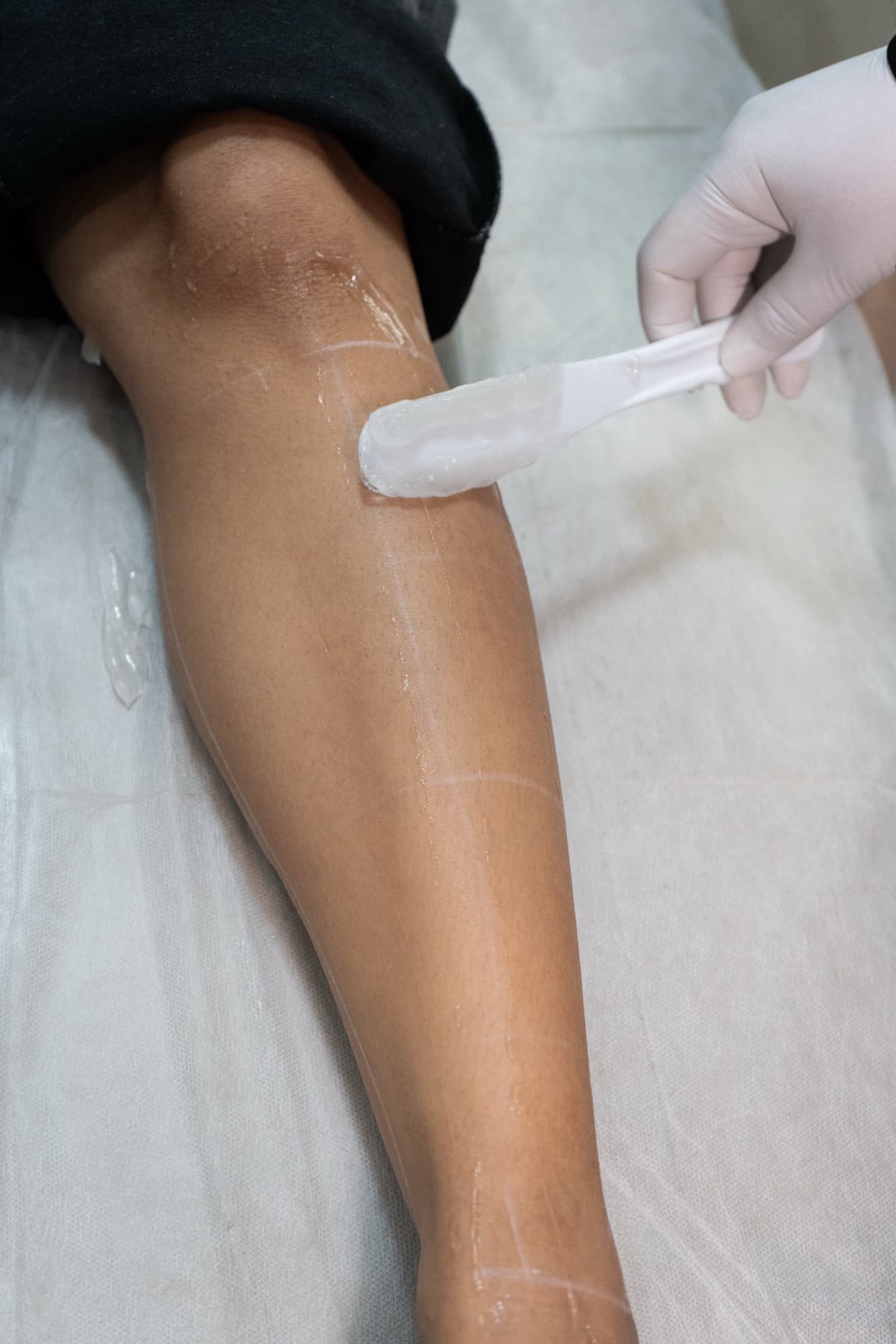 Cooling gel applied before laser hair removal