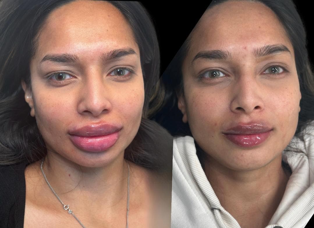 Before and after dissolving lip filler, showing a reduction back to a natural lip shape