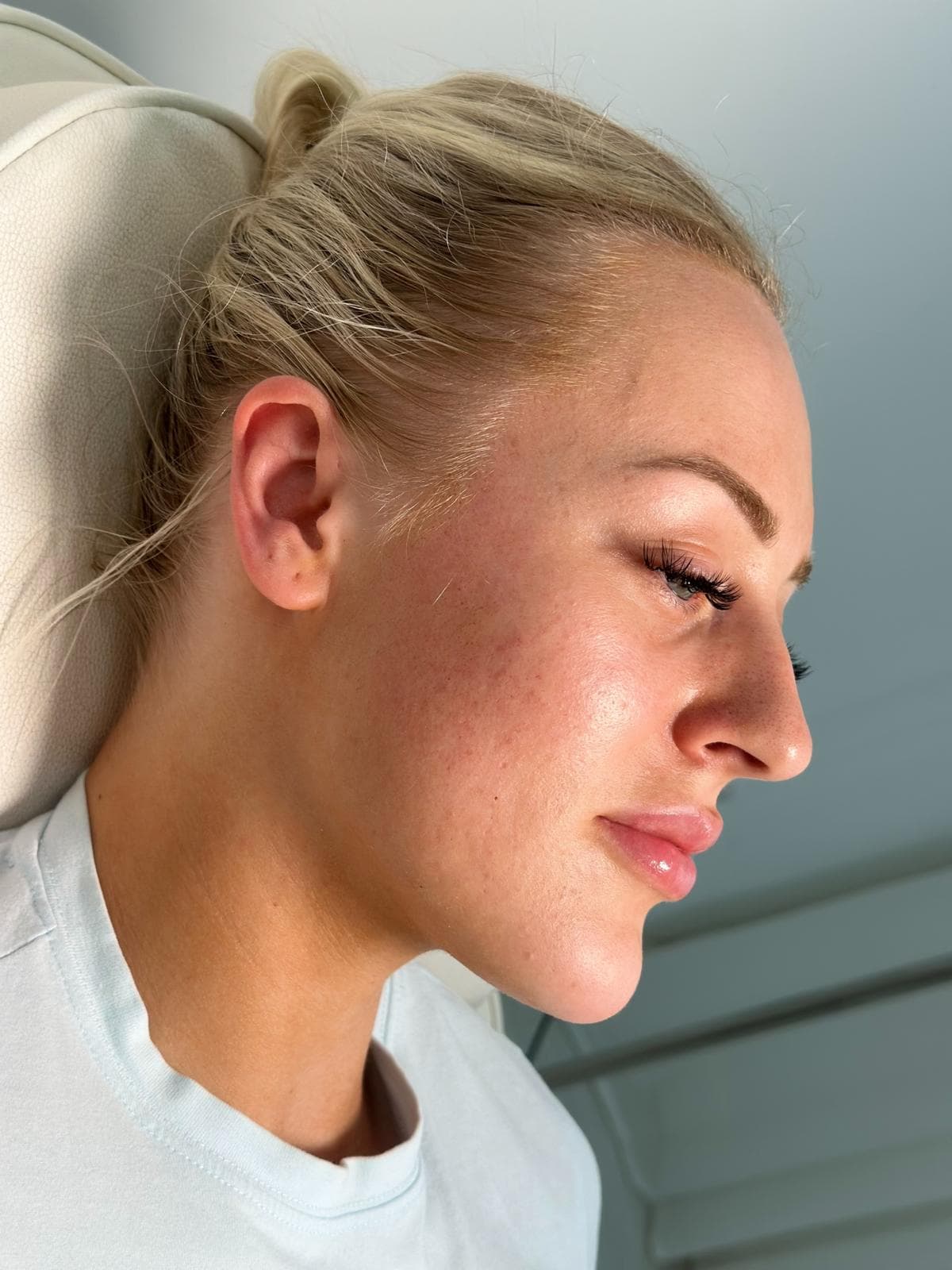 Profile balancing filler result, close-up side profile