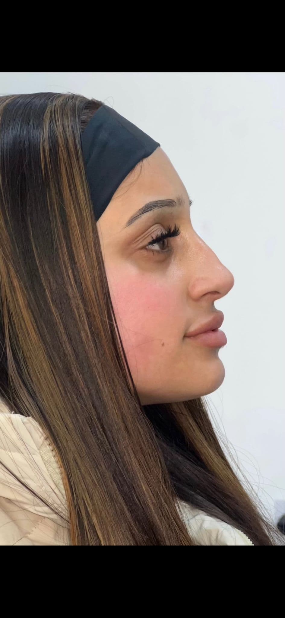 Non-surgical rhinoplasty filler result, side profile