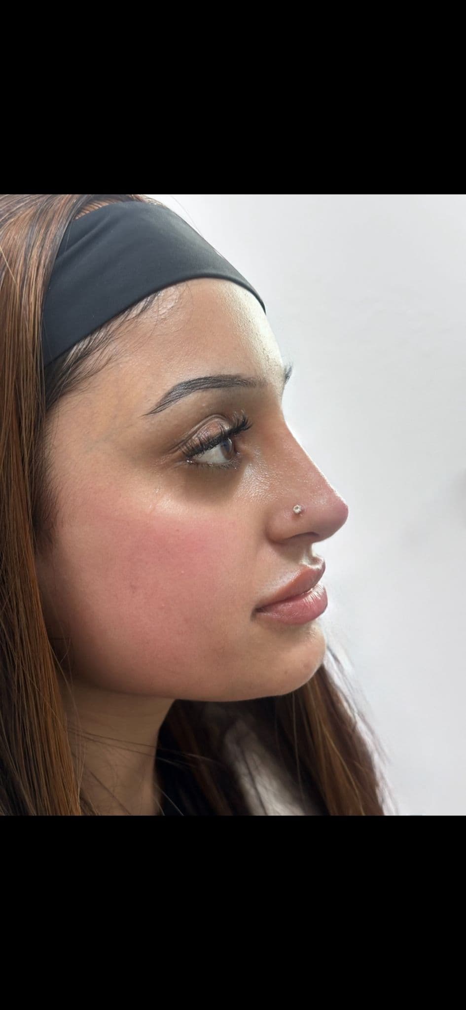 Non-surgical rhinoplasty filler result, close-up side profile