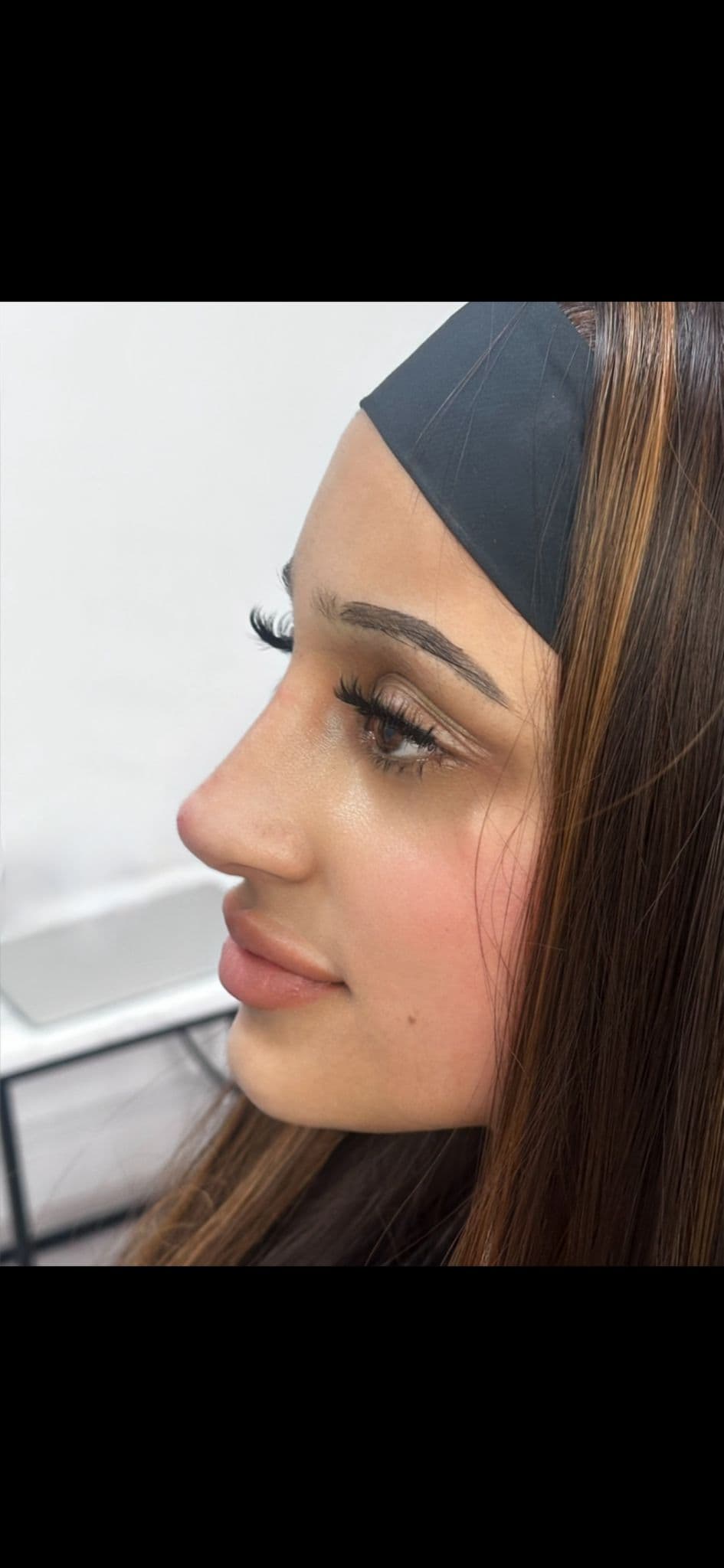 Non-surgical rhinoplasty filler result, side profile detail