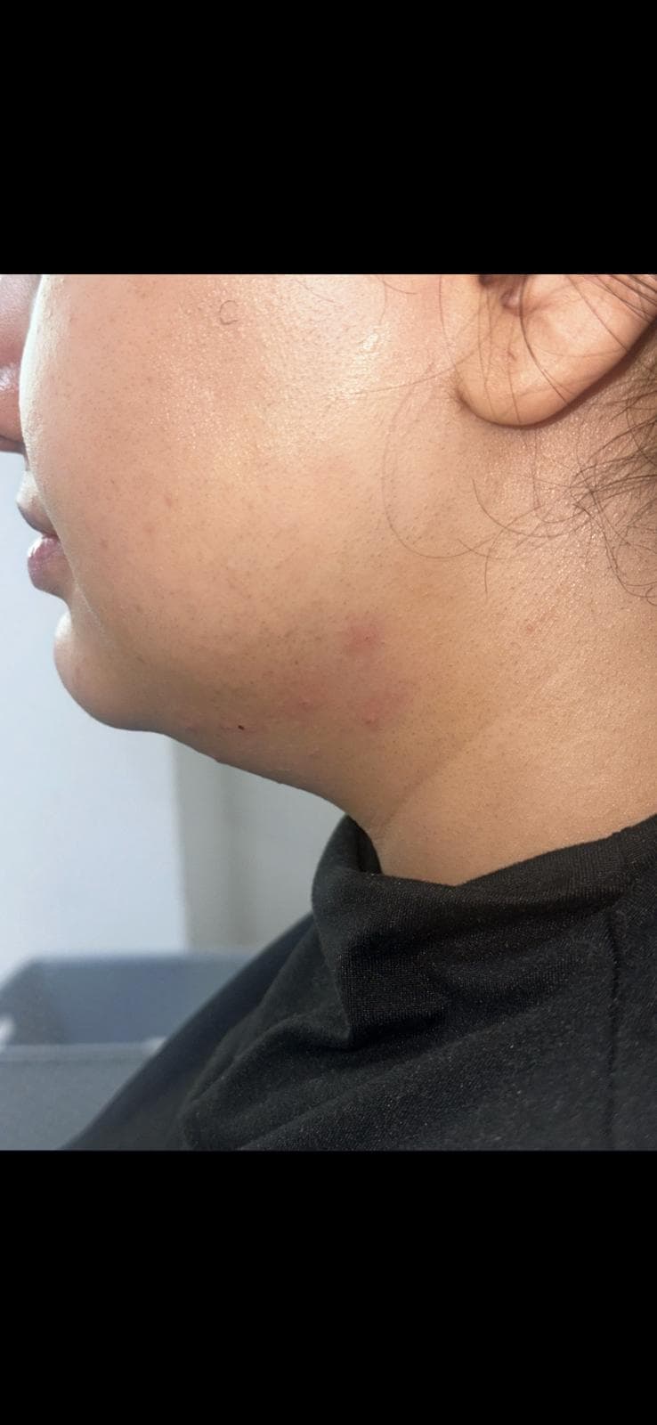 Lemon Bottle fat dissolving result, jaw and neck area