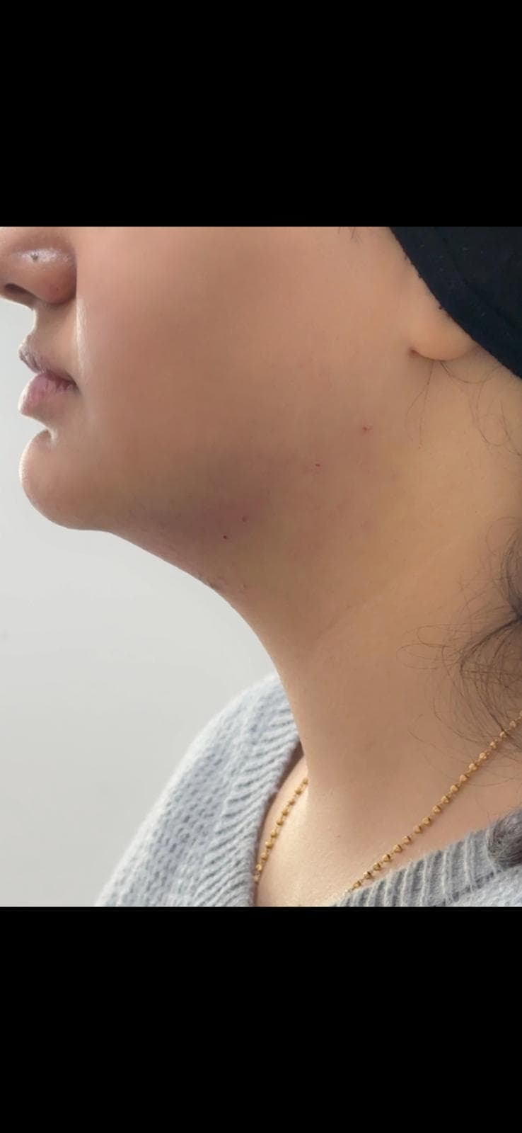 Lemon Bottle fat dissolving result, jaw and neck area, second photo