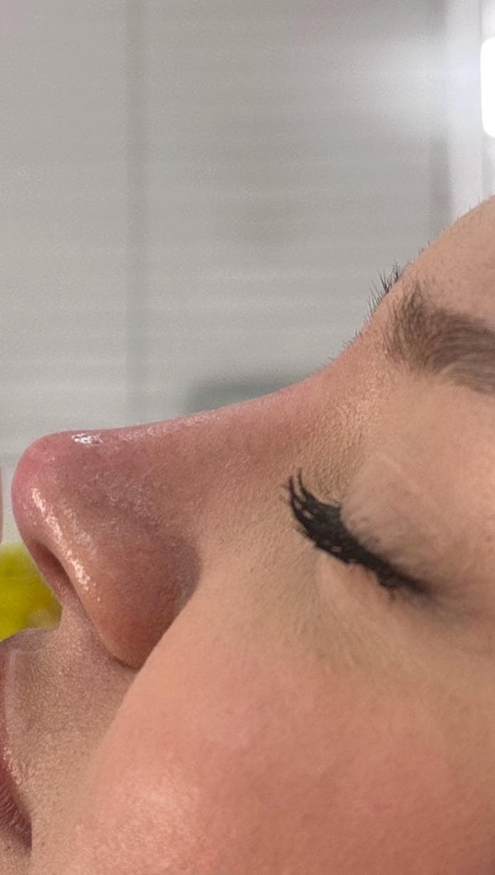 Non-surgical rhinoplasty result, close-up side profile, second photo