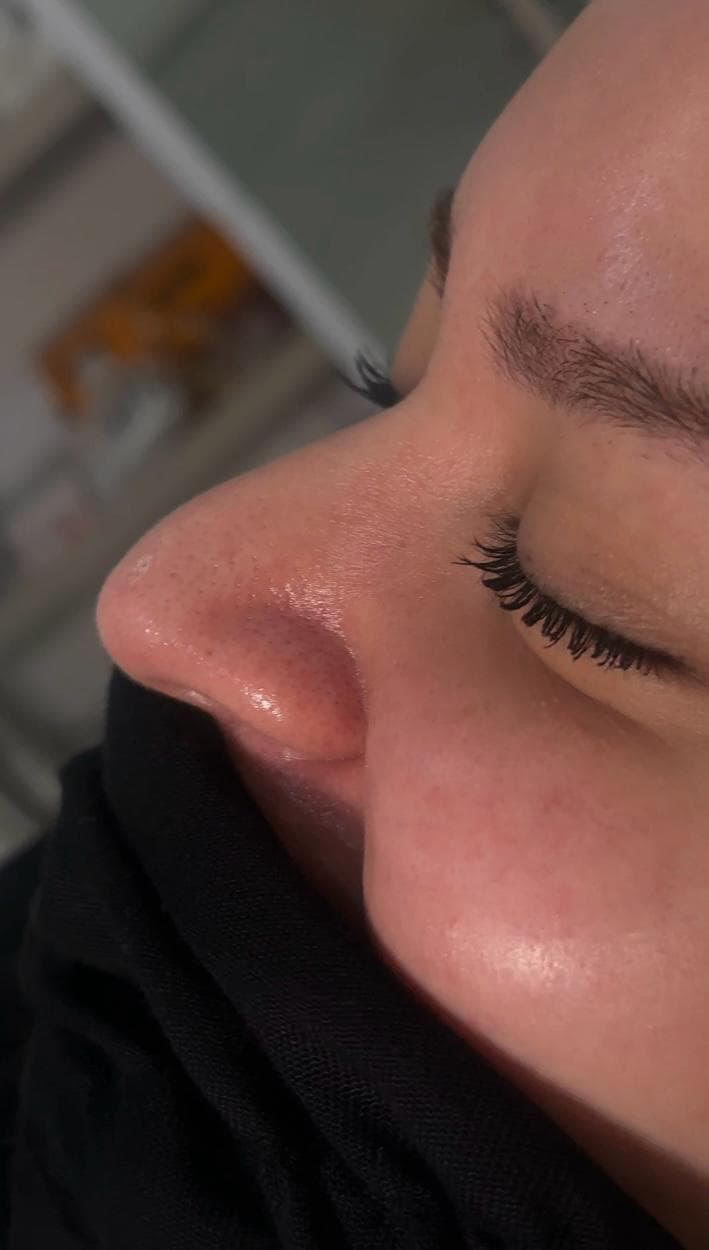 Non-surgical rhinoplasty result, close-up side profile, third photo