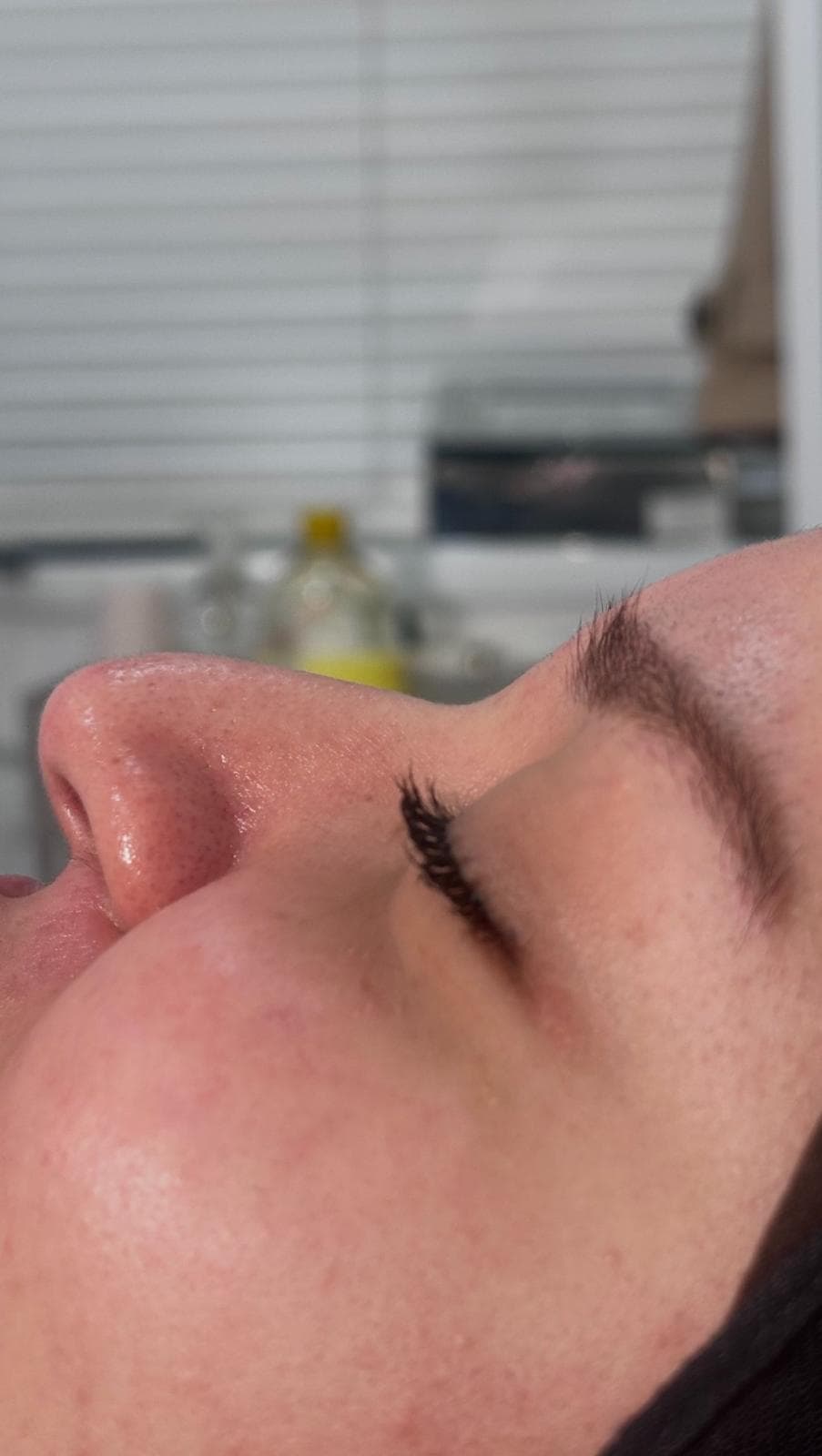 Non-surgical rhinoplasty result, close-up profile, fourth photo