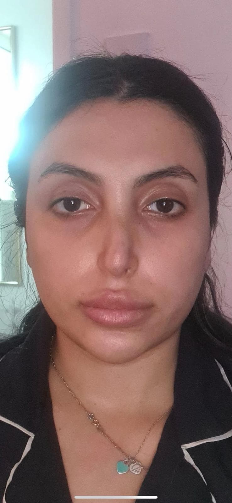 Nose filler dissolve result, front view