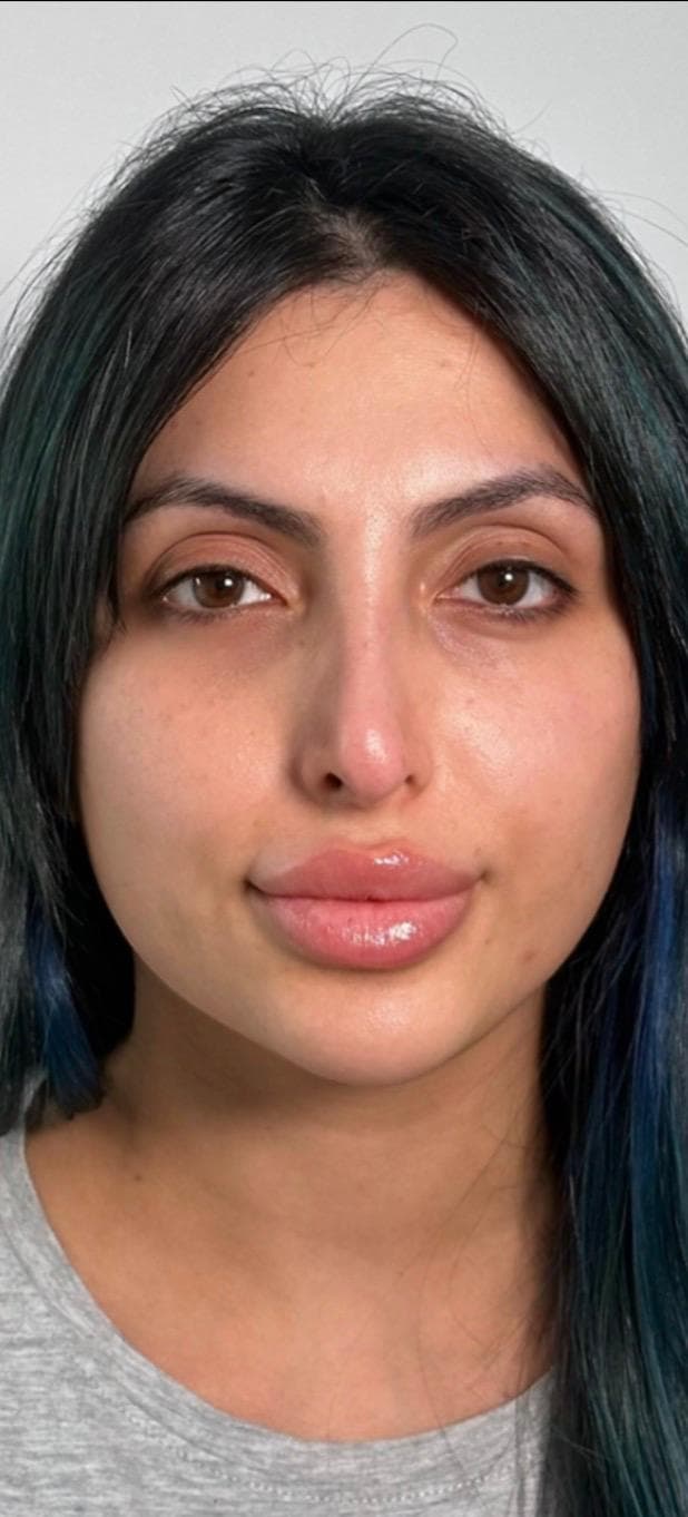 Nose filler dissolve result, front view, second client